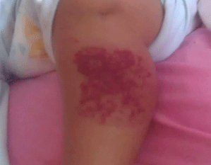 广州哪家医院看草莓状血管瘤好