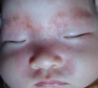 佛山市治疗鲜红斑痣好的医院是哪家