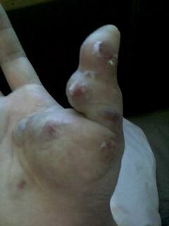 海绵状血管瘤广州哪个医院治得好