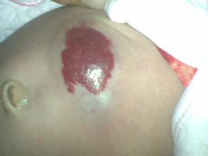 佛山治疗混合型血管瘤费用高吗