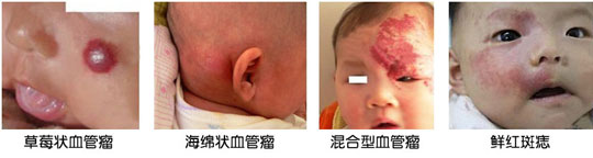 婴儿血管瘤的种类和症状有哪些