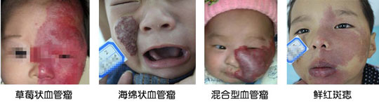 孩子身上的红胎记是鲜红斑痣吗