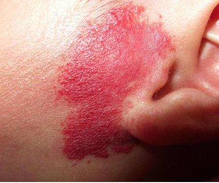 广州有治疗鲜红斑痣的医院吗