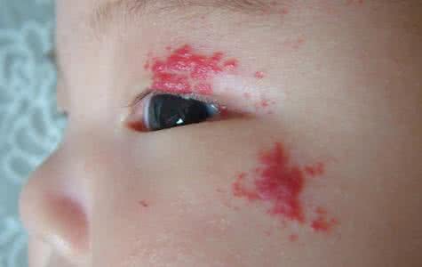 什么是婴儿血管瘤