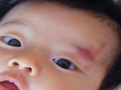 宝宝长了鲜红斑痣怎么办