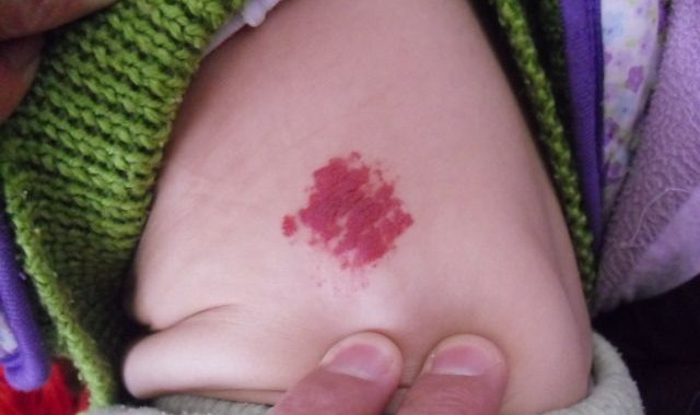 ����Ƥ���ϵĺ�ɫ͹���ǲ���Ѫ����