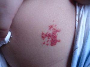 新生儿血管瘤会自己消退吗