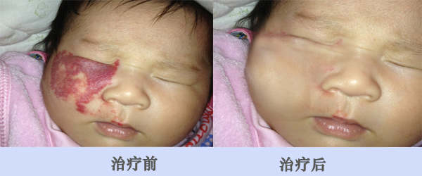 孩子眼睛下面长了鲜红斑痣怎么办