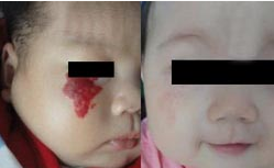 治婴儿血管瘤佛山哪家医院较正规