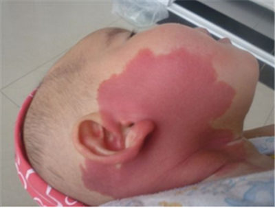 佛山有治疗鲜红斑痣的专科医院吗