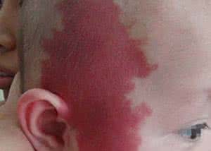 怎么判断孩子长得是不是鲜红斑痣