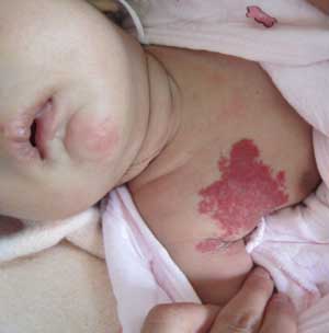 佛山哪家血管瘤医院比较靠谱