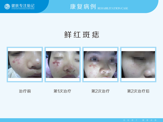 佛山治疗鲜红斑痣哪种技术可靠