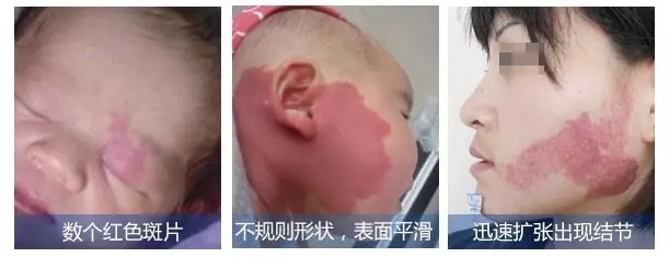 广州鲜红斑痣医院排行榜