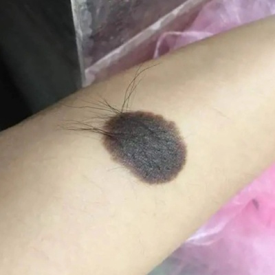 黑毛痣不治疗有哪些后果？