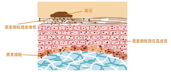 新生儿的胎记怎么形成的